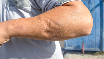 Scars and Disfigurement